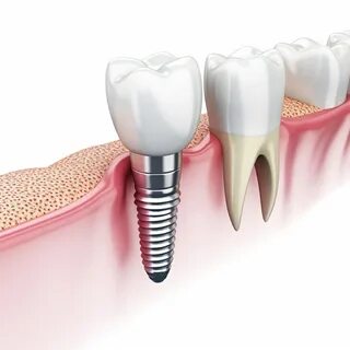 Имплантация