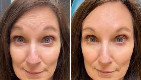 Baby Botox: All You Need to Know - Eugenie Brunner, M.D., F.A.C.S