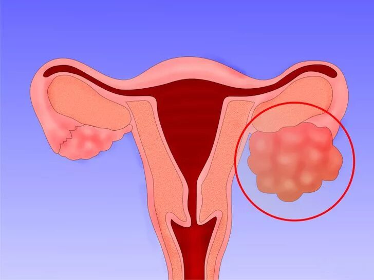 Лечение и поддержка при раке яичников 3 стадии