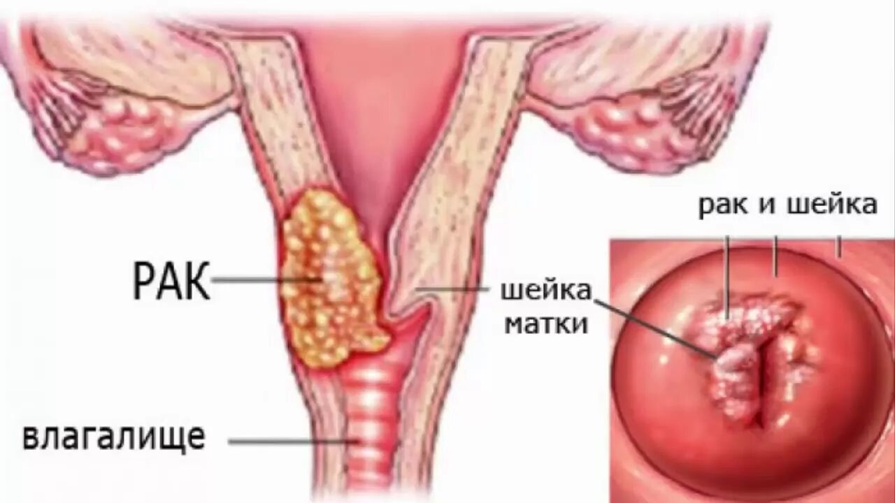 Рак матки 3 стадии: тактика лечения и главные точки опоры